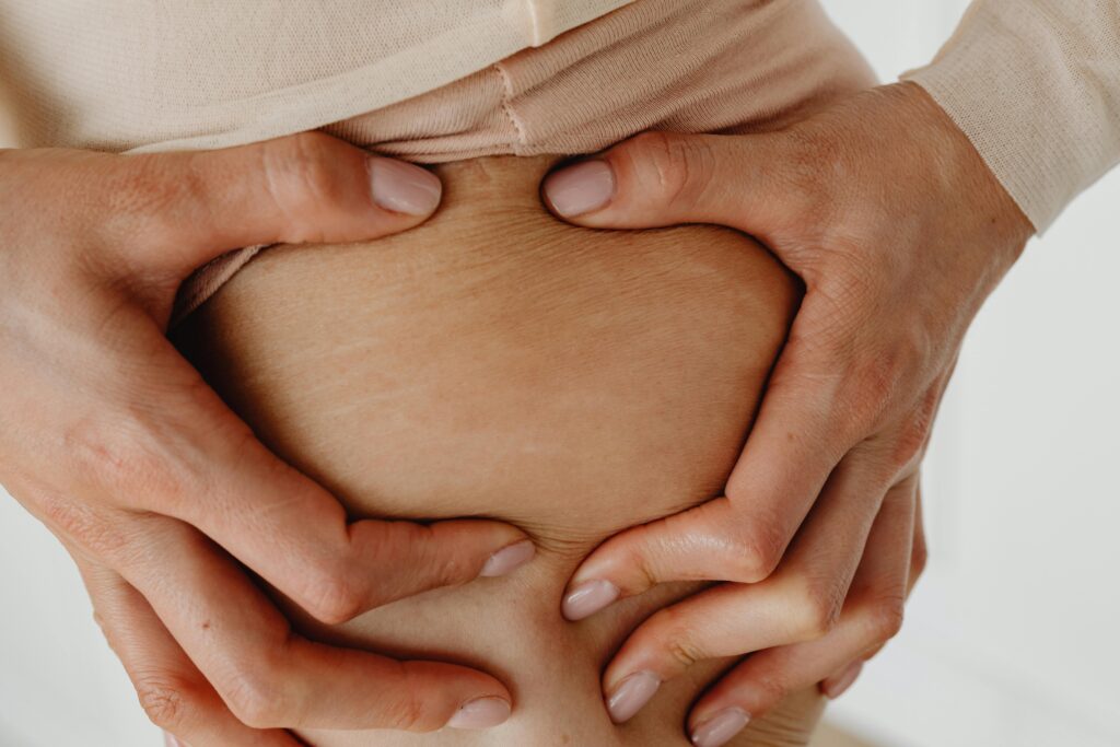 A detailed close-up showing a woman's hands holding her skin, focusing on stretch marks.